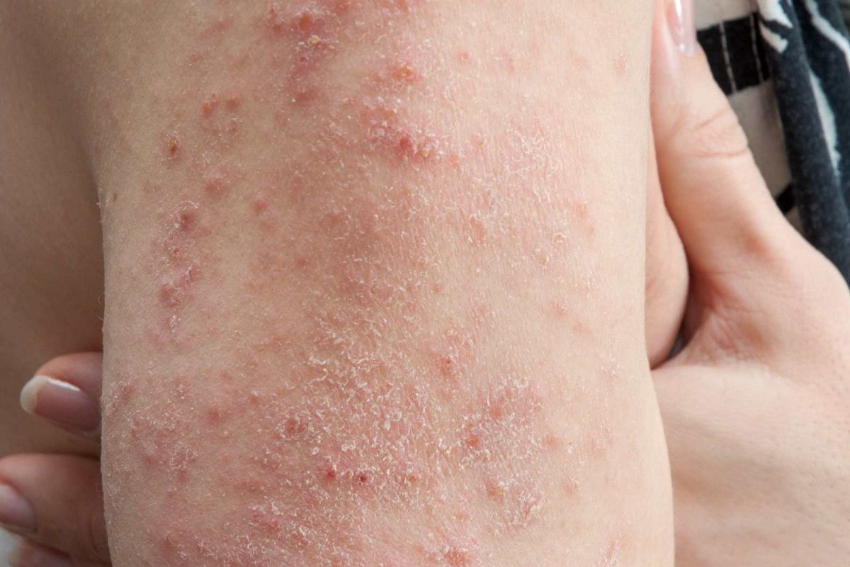 was-ist-dermatitis-definition-webhotels